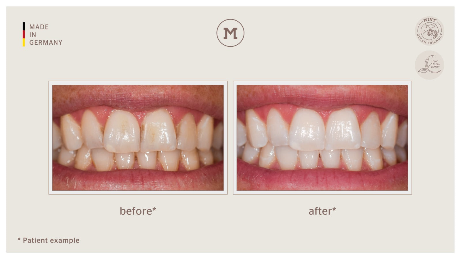HOLLYWOOD WHITENING SPECIAL SET