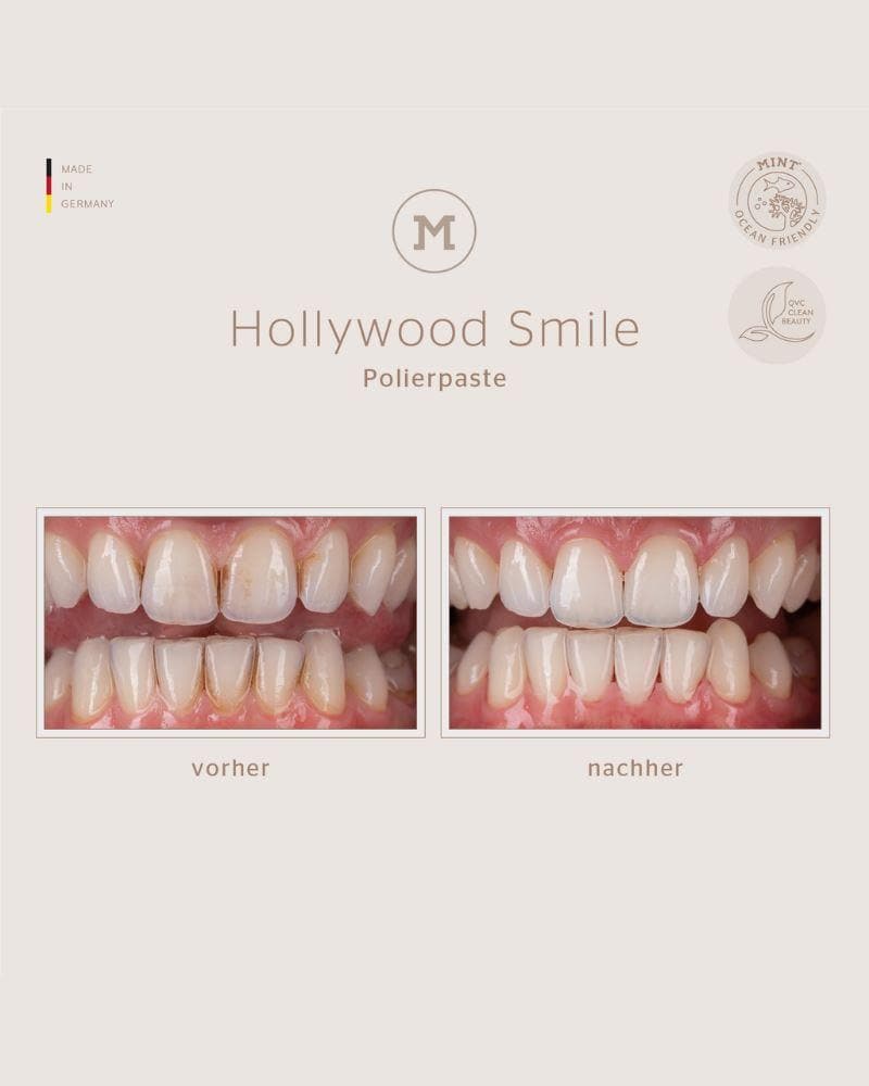 MINT Hollywood Smile vorher nachher Schaubild
