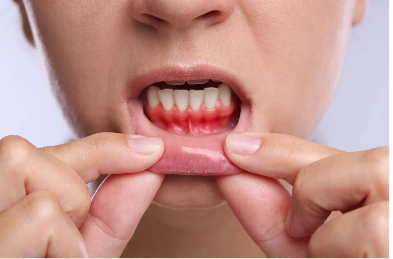 Zahnfleischentzündung behandeln: Was hilft wirklich?