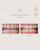 MINT Hollywood Smile Polishing Paste – Before and After Example